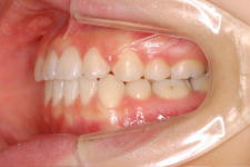 中立咬合、両突歯列、左側偏位顎　治療後　写真3