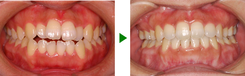 開咬合、両突歯列、叢生、右側偏位顎　治療前後　写真1