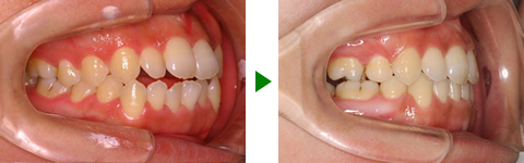 開咬合、両突歯列、叢生、右側偏位顎　治療前後　写真2