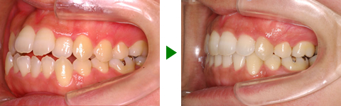 開咬合、両突歯列、叢生、右側偏位顎　治療前後　写真3
