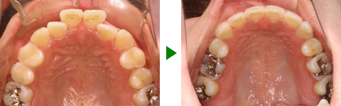 開咬合、両突歯列、叢生、右側偏位顎　治療前後　写真4