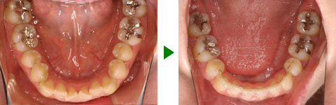 開咬合、両突歯列、叢生、右側偏位顎　治療前後　写真5