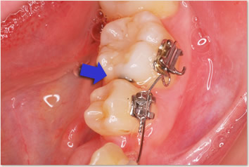 矢印の部位が隣接面のう蝕。矯正治療によりスペースを開けてから治療をおこなった