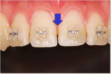 歯と歯の接触点を削った所