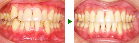 中立咬合、叢生、両突、右側偏位顎　治療前後　写真1