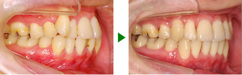 中立咬合、叢生、両突、右側偏位顎　治療前後　写真2