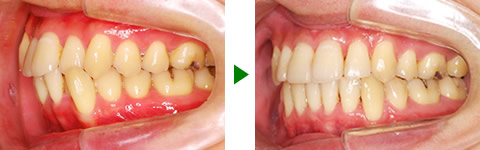 中立咬合、叢生、両突、右側偏位顎　治療前後　写真3