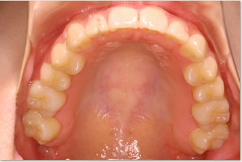 再診時（非抜歯治療後）の画像(上顎)