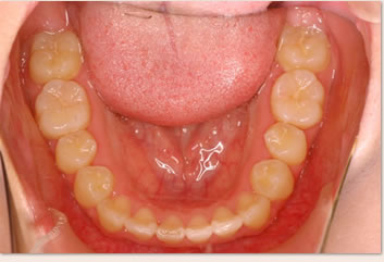 再診時（非抜歯治療後）の画像(下顎)