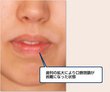 歯列の拡大により口唇閉鎖が困難になった状態