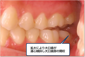 拡大により大臼歯が遠心傾斜し大臼歯部の開咬