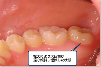 拡大により大臼歯が遠心傾斜し埋伏した状態