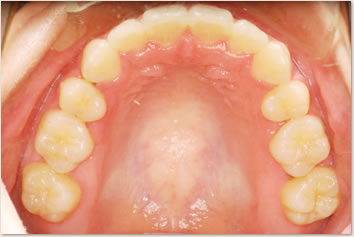 動的治療終了時(上顎)