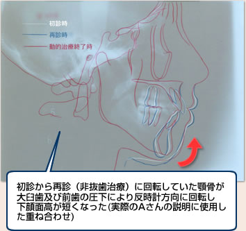 初診から再診（非抜歯治療）に回転していた顎骨が大臼歯及び前歯の圧下により反時計方向に回転し下顔面高が短くなった（実際のＡさんの説明に使用した重ね合わせ）