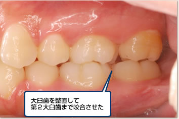 大臼歯を整直して第2大臼歯まで咬合させた