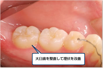 大臼歯を整直して埋伏を改善