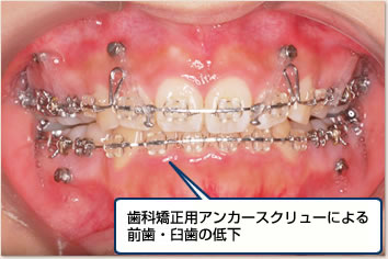 歯科矯正用アンカースクリューによる前歯・臼歯の低下