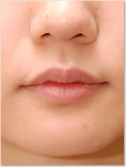  赤唇部の厚みも減少し理想的な唇の厚みに変化