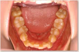 上突咬合・両突歯列・叢生歯列　開始前　下顎