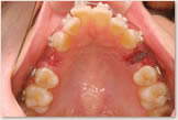上突咬合・両突歯列・叢生歯列　開始時　上顎