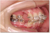 上突咬合・両突歯列・叢生歯列　開始時　右側