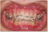 上突咬合・両突歯列・叢生歯列　開始時　正面