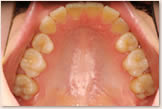 上突咬合・両突歯列・叢生歯列　終了後　上顎