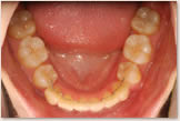 上突咬合・両突歯列・叢生歯列　終了後　下顎