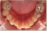 上突咬合、両突歯列　治療前　下顎