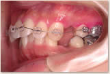 上突咬合、両突歯列 治療開始後　左側