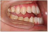 開咬をともなう骨格性下顎前突症 治療前　右側