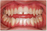 開咬をともなう骨格性下顎前突症 治療前　正面