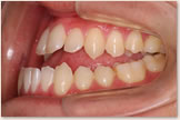 開咬をともなう骨格性下顎前突症 治療前　左側