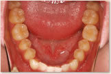 開咬をともなう骨格性下顎前突症 治療前　下顎