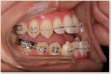 開咬をともなう骨格性下顎前突症 開始後　左側