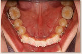 開咬をともなう骨格性下顎前突症 開始後　下顎
