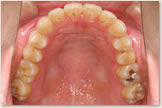 開咬をともなう骨格性下顎前突症 治療後　上顎