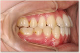 開咬をともなう骨格性下顎前突症 治療後　右側