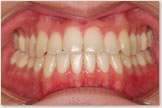 開咬をともなう骨格性下顎前突症 治療後　正面