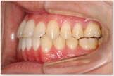開咬をともなう骨格性下顎前突症 治療後　左側