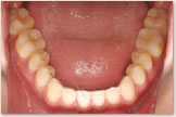開咬をともなう骨格性下顎前突症 治療後　下顎