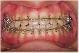 開咬をともなう骨格性下顎前突症 退院後　正面