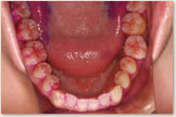 下顎歯列の歯の磨き残し（PCR）比較　治療開始時