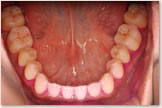 下顎歯列の歯の磨き残し（PCR）比較　治療終了時