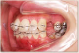 上突歯列・上突咬合・叢生歯列・下後退顎 開始後　左側