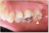 矢頭（▲）が示す歯は牽引した右上８番