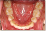治療後　下顎