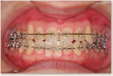 術前矯正治療終了時（動的治療開始から25ヵ月後）　正面