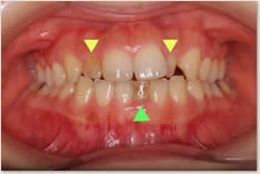 ▼矮小化した上顎左右側切歯（左右上2番）
 ▲ 晩期残存した下顎左側乳中切歯（左下Ａ）