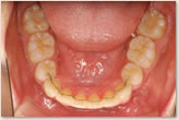 動的治療後　下顎